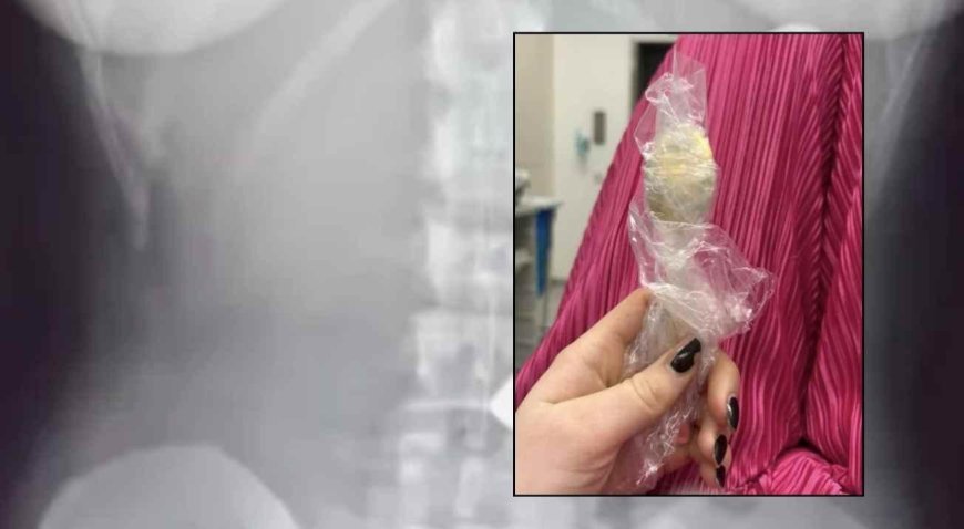 SON DAKİKA HABERLER: .Yoğurt yerken bir anda oldu, söylemeye utandı! Tam 17 santimetre büyüklüğünde, 2 gün vücudunda kaldı