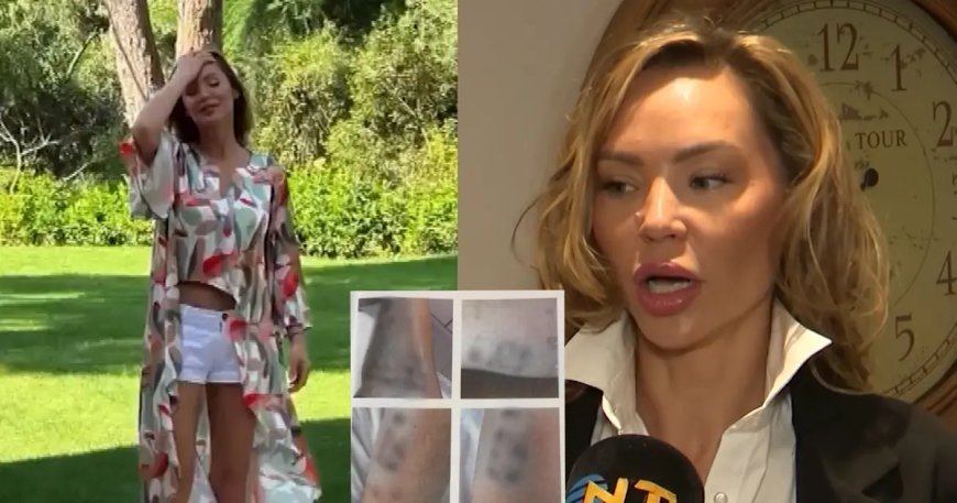 Şişli'de estetik yaptırmak isteyen mankenin vücudu yandı. Dizilerde oynuyordu, işinden oldu