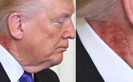 Trump’ın boynundaki kızarıklık hakkında doktorundan açıklama