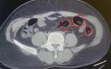 Yolcu otobüsünde şoke eden operasyon! Mide ve bağırsaklarından yarım kilo uyuşturucu çıktı