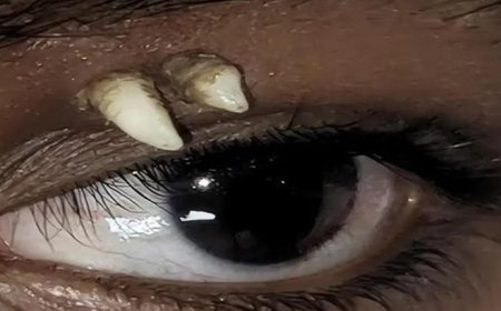 Doktorlar şaşkına döndü! Gözünden diş çıktı: 'İlk ve tek vaka'